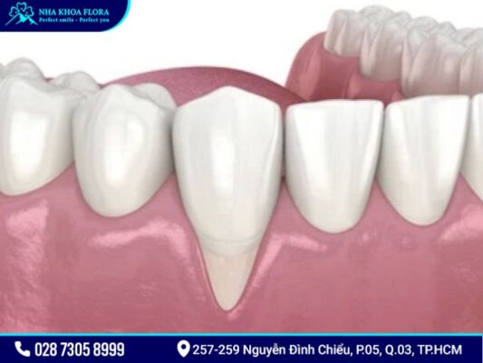 tụt lợi - ảnh 2 tụt lợi - ảnh 2