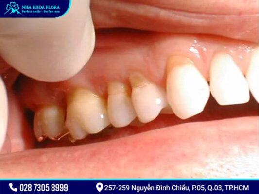 tụt lợi - ảnh 3 tụt lợi - ảnh 3