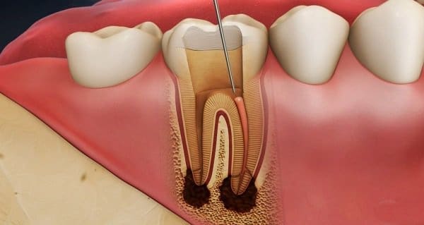 bien-chung-boc-rang-su biến chứng bọc răng sứ