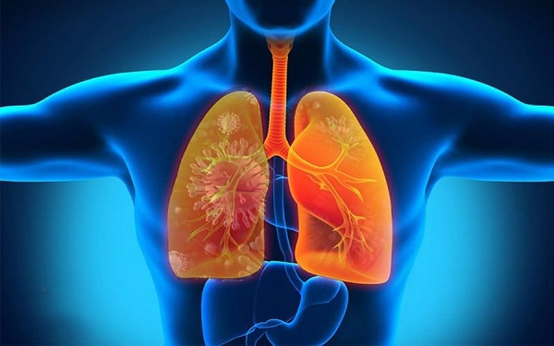 Viêm phổi cũng có thể gây nên mùi hôi miệng (ảnh minh họa) Viêm phổi cũng có thể gây nên mùi hôi miệng (ảnh minh họa)