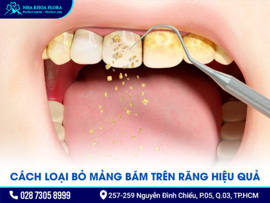 mảng bám trên răng - ảnh 3 mảng bám trên răng - ảnh 3