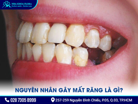 Nguyên nhân gây mất răng - ảnh 1 Nguyên nhân gây mất răng - ảnh 1