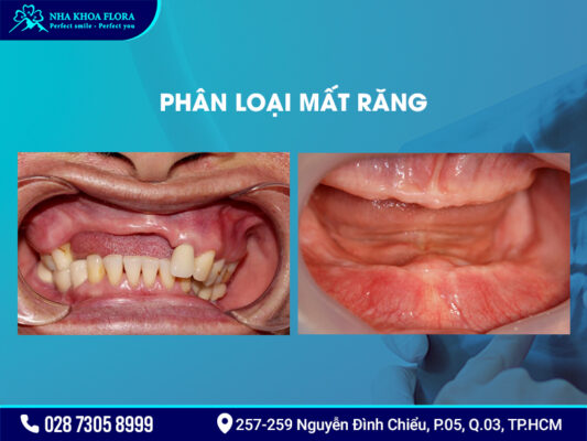 Nguyên nhân gây mất răng - ảnh 2 Nguyên nhân gây mất răng - ảnh 2