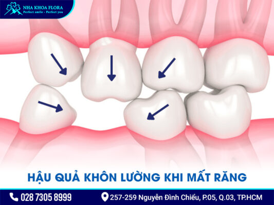 Nguyên nhân gây mất răng - ảnh 3 Nguyên nhân gây mất răng - ảnh 3