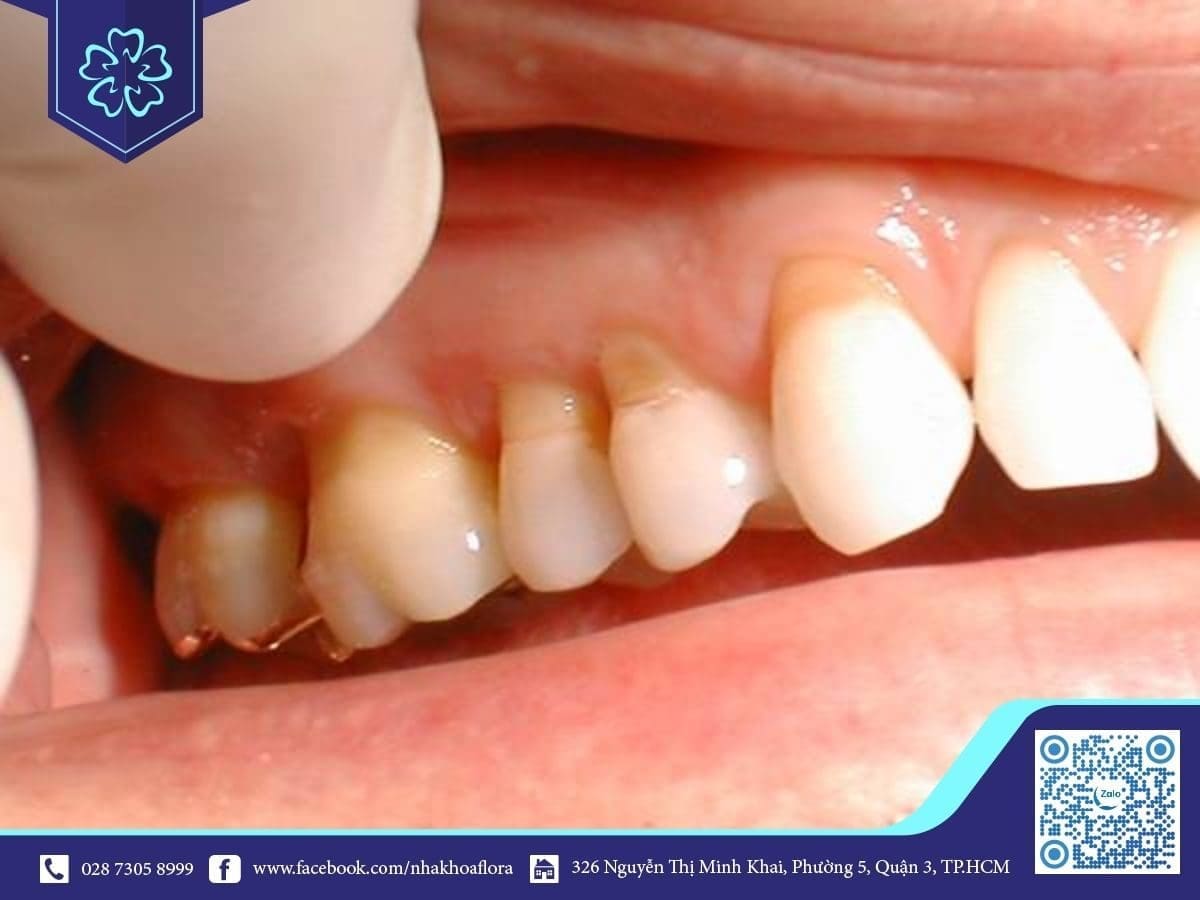 Bọc răng sứ giá rẻ gây hở cổ chân răng, mất thẩm mỹ (ảnh minh họa) Bọc răng sứ giá rẻ gây hở cổ chân răng, mất thẩm mỹ (ảnh minh họa)