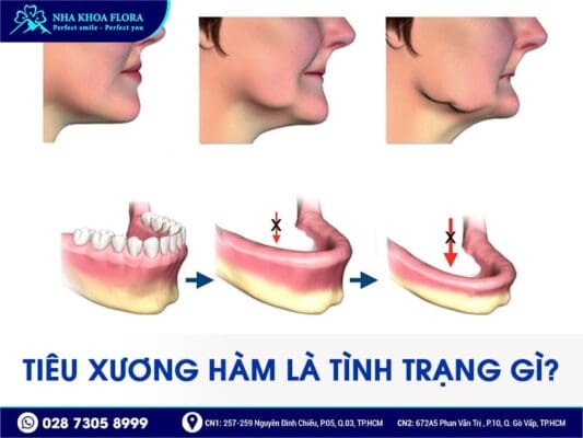mất răng bao lâu thì bị tiêu xương hàm - ảnh 1 mất răng bao lâu thì bị tiêu xương hàm - ảnh 1