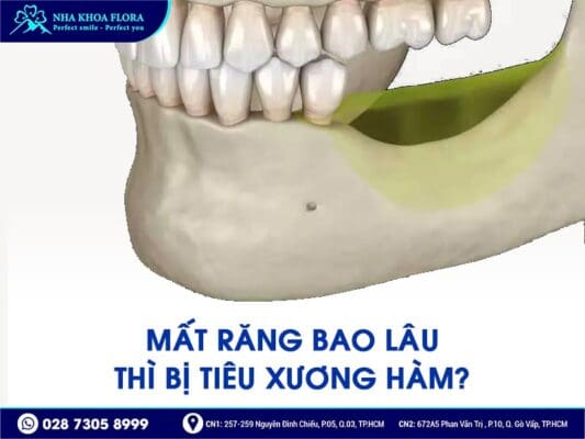 mất răng bao lâu thì bị tiêu xương hàm - ảnh 2 mất răng bao lâu thì bị tiêu xương hàm - ảnh 2