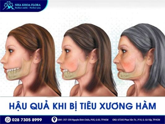 mất răng bao lâu thì bị tiêu xương hàm - ảnh 4 mất răng bao lâu thì bị tiêu xương hàm - ảnh 4