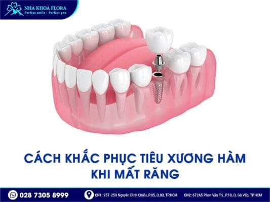 mất răng bao lâu thì bị tiêu xương hàm - ảnh 5 mất răng bao lâu thì bị tiêu xương hàm - ảnh 5
