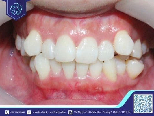Người có răng khểnh là người như thế nào? - Ảnh 3 Người có răng khểnh là người như thế nào? - Ảnh 3