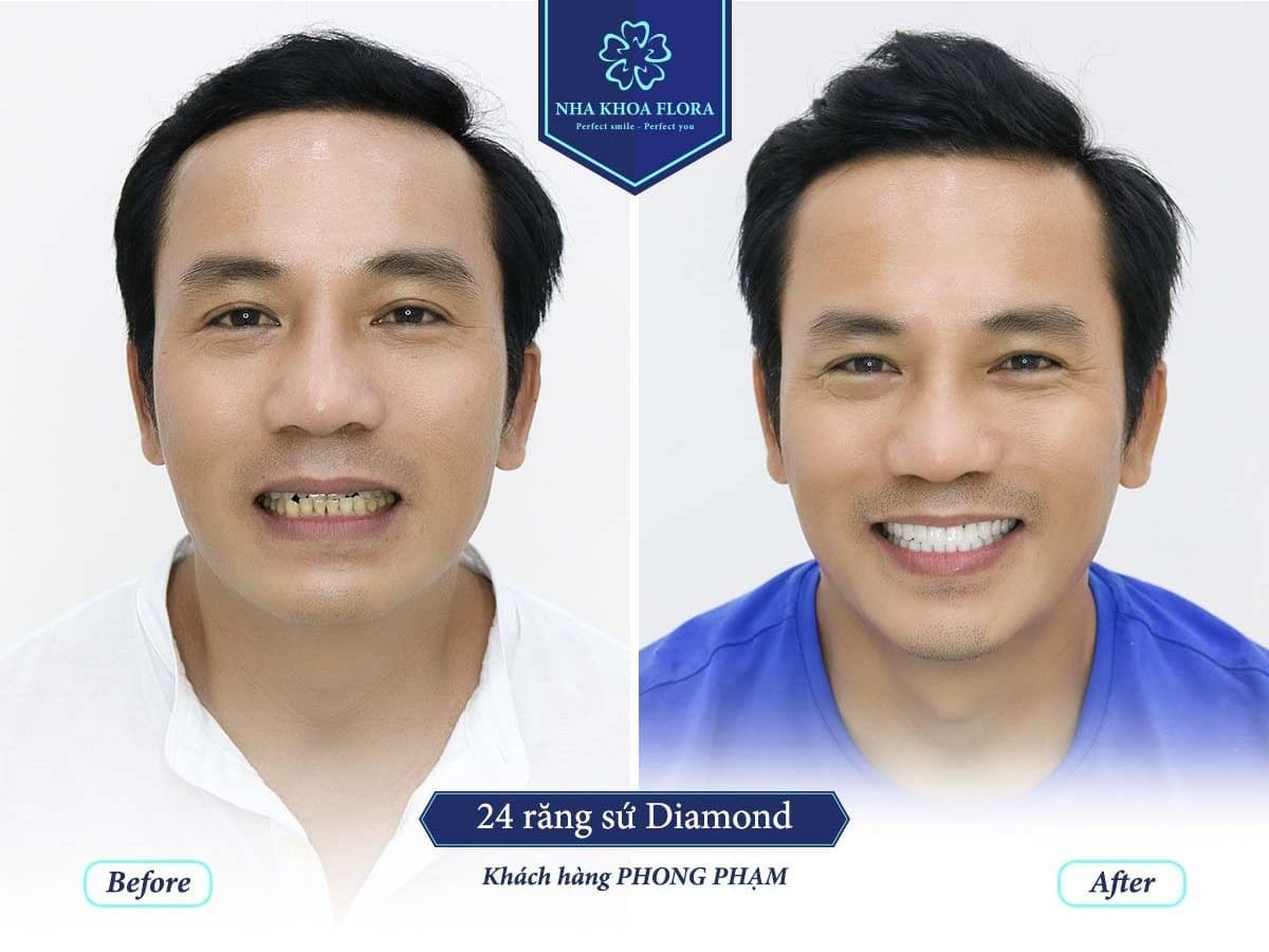 Răng sứ bao lâu thì ăn được? (ảnh minh họa) Răng sứ bao lâu thì ăn được? (ảnh minh họa)