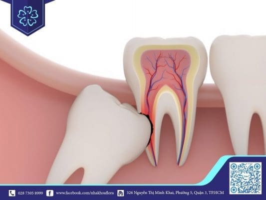 Răng số 8 mọc lệch (ảnh minh họa) Răng số 8 mọc lệch (ảnh minh họa)