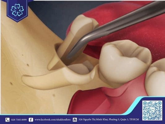Nhổ răng số 8 (ảnh minh họa) Nhổ răng số 8 (ảnh minh họa)