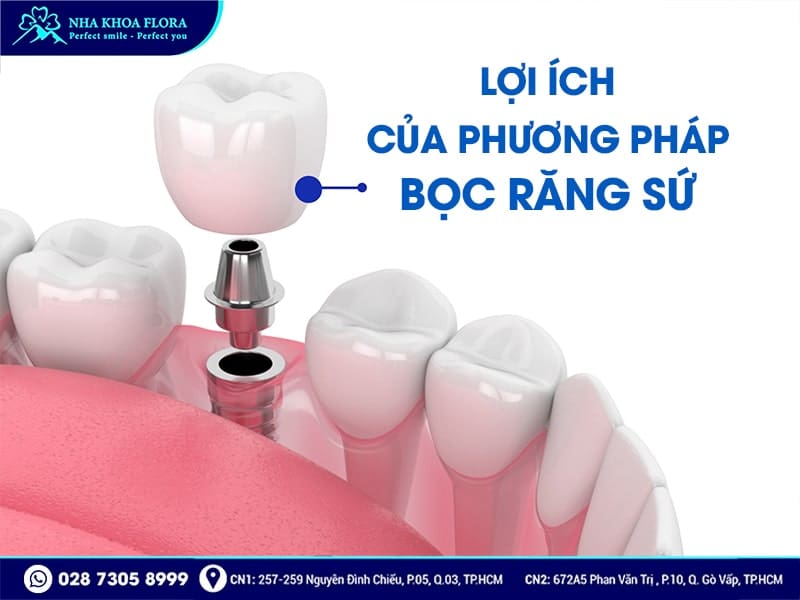 Bọc răng sứ có bền không? - Ảnh 1 Bọc răng sứ có bền không? - Ảnh 1