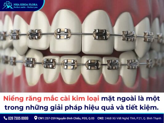 Các loại niềng răng - ảnh 1 Các loại niềng răng - ảnh 1
