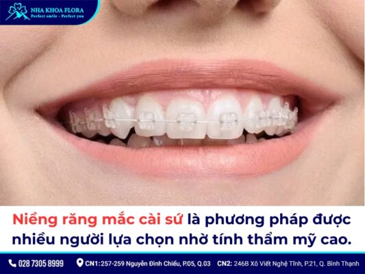 Các loại niềng răng - ảnh 2 Các loại niềng răng - ảnh 2