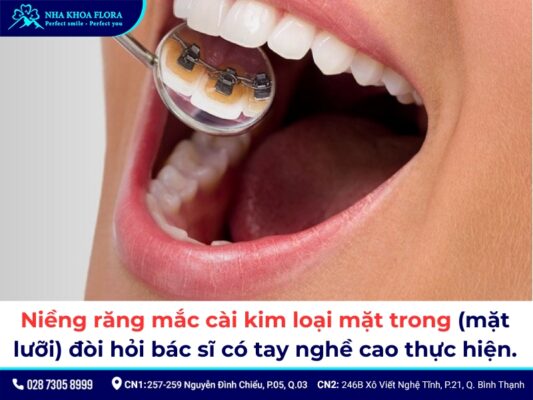 Các loại niềng răng - ảnh 3 Các loại niềng răng - ảnh 3