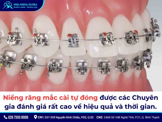 Các loại niềng răng - ảnh 4 Các loại niềng răng - ảnh 4