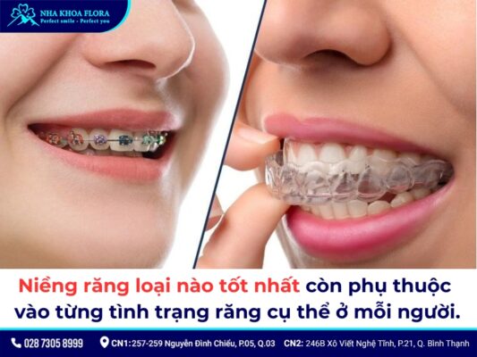 Các loại niềng răng - ảnh 6 Các loại niềng răng - ảnh 6