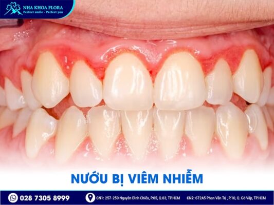 biến chứng sau phẫu thuật hở lợi - ảnh 1 biến chứng sau phẫu thuật hở lợi - ảnh 1