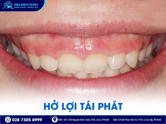 biến chứng sau phẫu thuật hở lợi - ảnh 4 biến chứng sau phẫu thuật hở lợi - ảnh 4