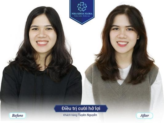 CƯỜI HỞ LỢI
