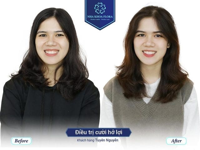 khach-hang-chua-cuoi-ho-loi-thanh-cong-tai-nha-khoa-flora Khách hàng chữa cười hở lợi thành công tại nha khoa Flora