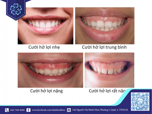 cac-muc-do-cuoi-ho-loi Các mức độ cười hở lợi (ảnh minh họa)