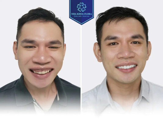 biến chứng cười hở lợi - ảnh 6 biến chứng cười hở lợi - ảnh 6