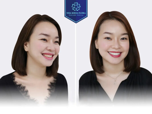 biến chứng cười hở lợi - ảnh 7 biến chứng cười hở lợi - ảnh 7