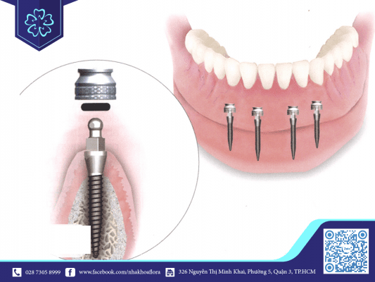 Cấy ghép bằng trụ Implant có kích thước nhỏ Cấy ghép bằng trụ Implant có kích thước nhỏ