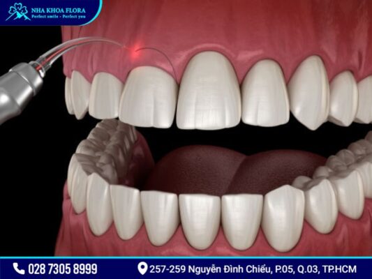 phẫu thuật cười hở lợi mất bao lâu - ảnh 2 phẫu thuật cười hở lợi mất bao lâu - ảnh 2