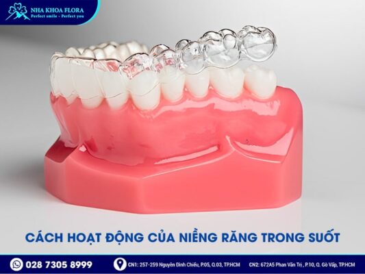 quá trình niềng răng trong suốt - ảnh 1 quá trình niềng răng trong suốt - ảnh 1