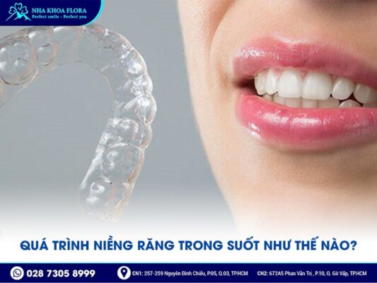 quá trình niềng răng trong suốt - ảnh 2 quá trình niềng răng trong suốt - ảnh 2