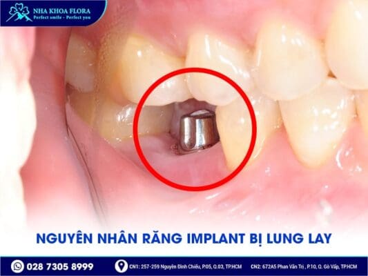 trụ implant bị lung lay - ảnh 1 trụ implant bị lung lay - ảnh 1