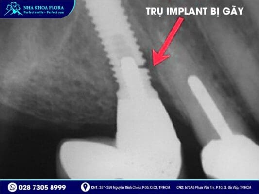 trụ implant bị lung lay - ảnh 2 trụ implant bị lung lay - ảnh 2