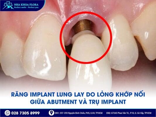 trụ implant bị lung lay - ảnh 3 trụ implant bị lung lay - ảnh 3