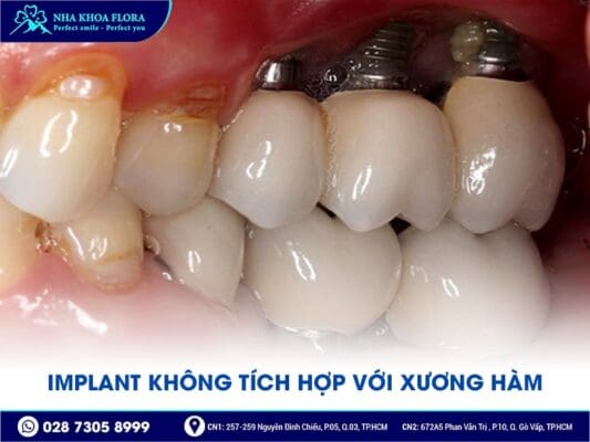 trụ implant bị lung lay - ảnh 4 trụ implant bị lung lay - ảnh 4