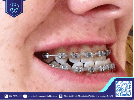nieng-rang-giup-dieu-tri-khop-can-nguoc Niềng răng giúp điều trị khớp cắn ngược