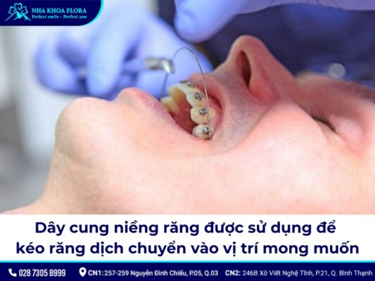 dây cung niềng răng - ảnh 1 dây cung niềng răng - ảnh 1