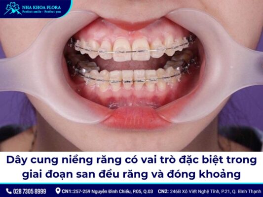 dây cung niềng răng - ảnh 2 dây cung niềng răng - ảnh 2