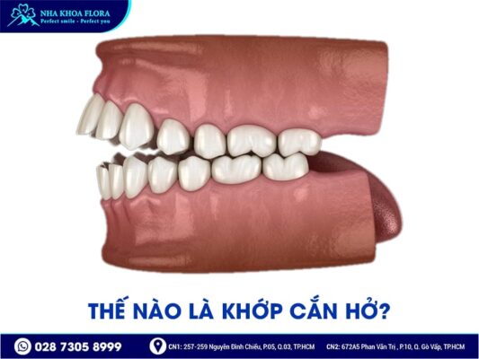 Khớp cắn hở - ảnh 1 Khớp cắn hở - ảnh 1