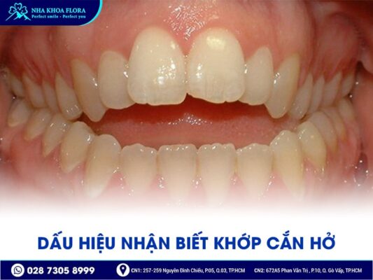 Khớp cắn hở - ảnh 2 Khớp cắn hở - ảnh 2