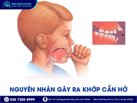 Khớp cắn hở - ảnh 3 Khớp cắn hở - ảnh 3