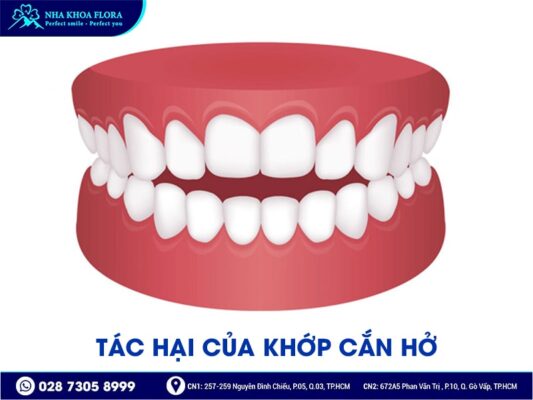 Khớp cắn hở - ảnh 4 Khớp cắn hở - ảnh 4