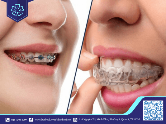 khuyen-cao-nieng-rang-mac-cai-va-nieng-rang-trong-suot Khuyến cáo niềng răng mắc cài và niềng răng trong suốt