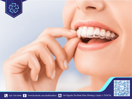 nieng-rang-doc-dao-invisalign Niềng răng độc đáo Invisalign