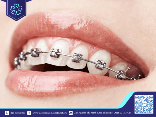 nieng-rang-tieng-anh-la-orthodontics-hoac-brace Niềng răng tiếng anh là Orthodontics hoặc Braces