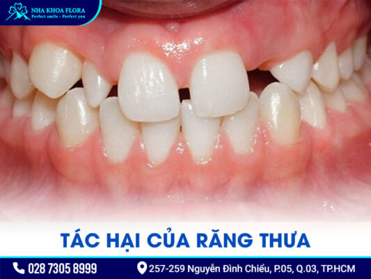 Răng thưa có niềng được không - ảnh 2 Răng thưa có niềng được không - ảnh 2