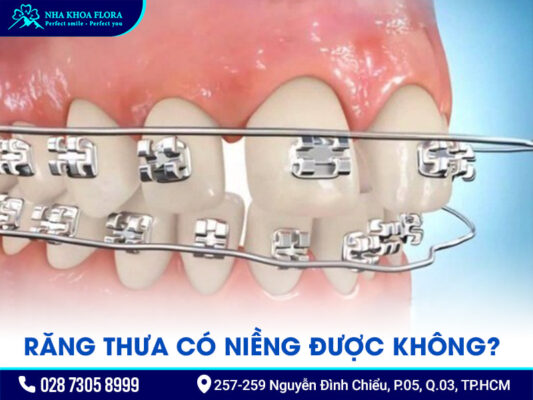 Răng thưa có niềng được không - ảnh 3 Răng thưa có niềng được không - ảnh 3
